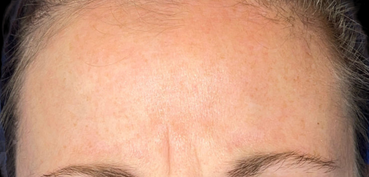 Woman's forehead before wrinkle relaxer procedure