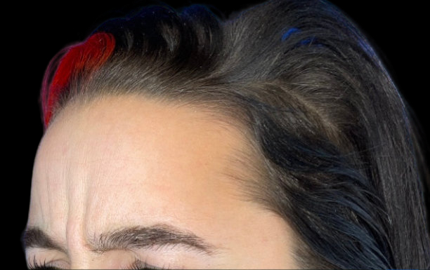 Female patient's forehead before botox treatment for 11's