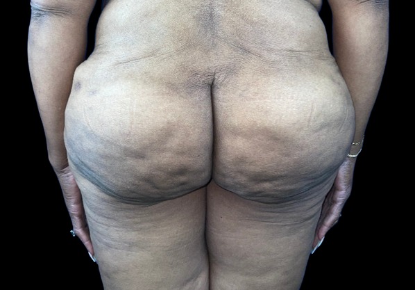 Female patient after flanks and buttock liposuction