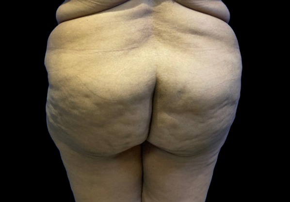 Female patient before flanks and buttock liposuction