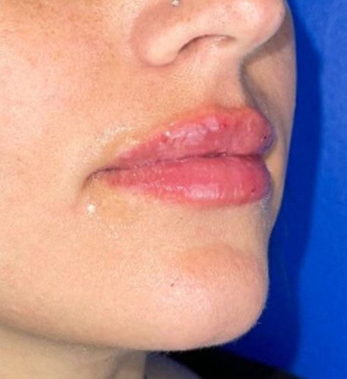 lip augmentation after
