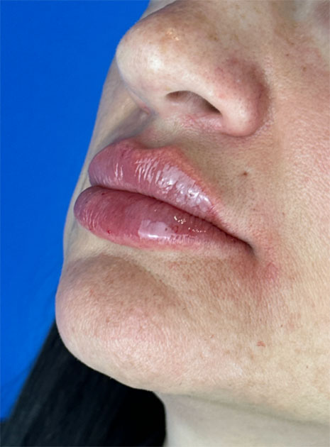 lip augmentation after