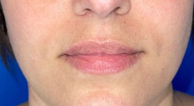 lip augmentation before
