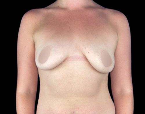 Female patient before breast augmentation with lift