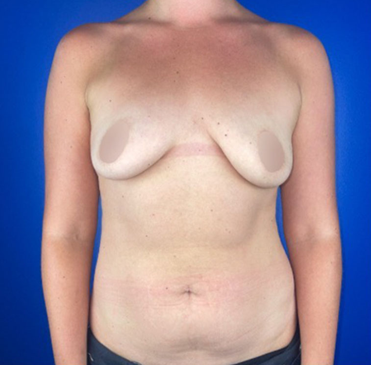 breast augmentation with lift before