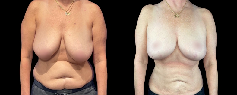 Female patient before and after breast lift