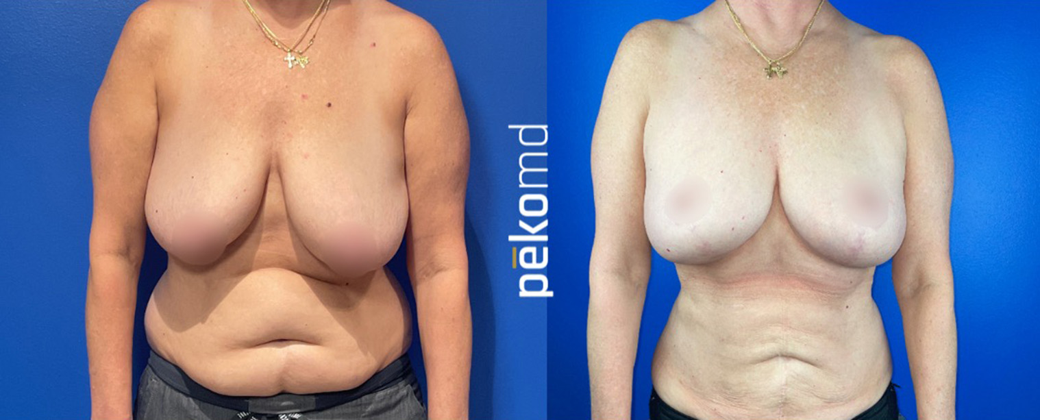 breast lift before&after