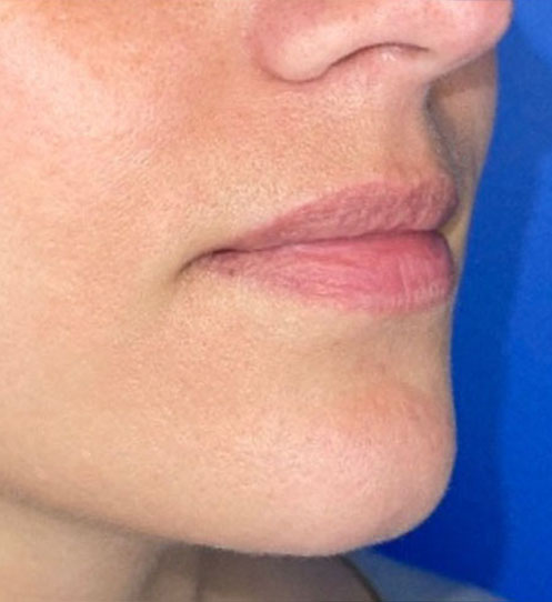 lip augmentation before