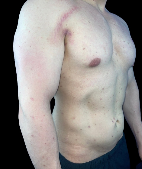 Man's torso after Lumecca treatment