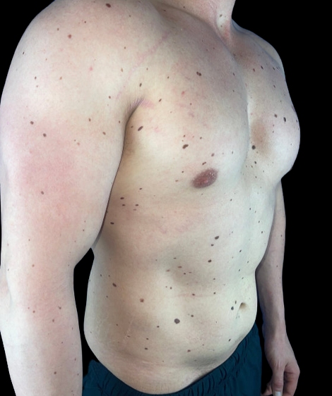 Man's torso before Lumecca treatment