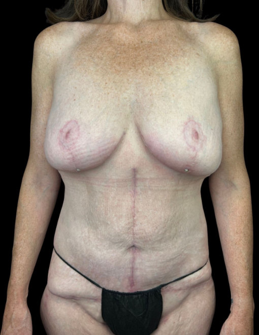 Frontal view of a torso showing surgical scars on abdomen and chest on a female body wearing black underwear.