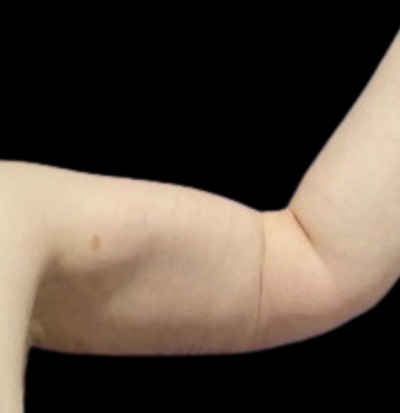 photo after arms lift procedure