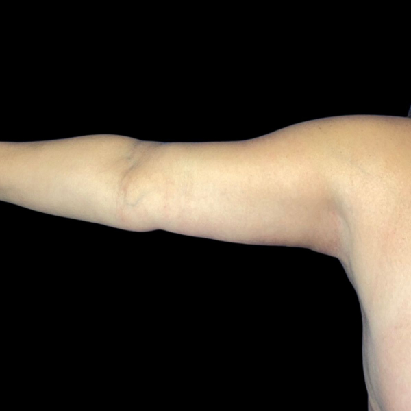 photo after arms lift procedure