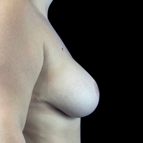 photo after breast lift procedure