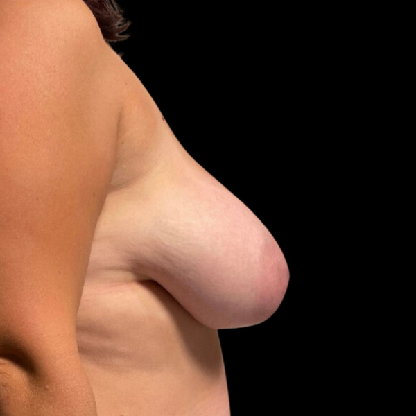 photo before breast lift procedure