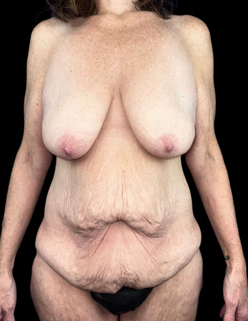 Close-up front view of a nude elderly woman with wrinkled skin, sagging breasts, and her arms raised, concealing her face.