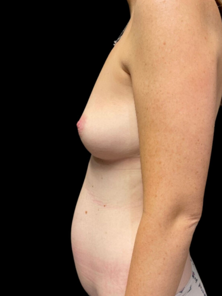 photo before breast augmentation procedure