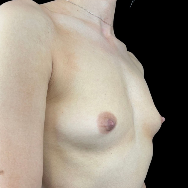 photo before breast augmentation procedure