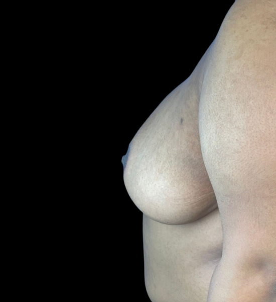 photo after breast reduction procedure