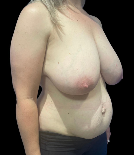 Close-up of an overweight woman's torso showing the chest and abdomen against a black background.