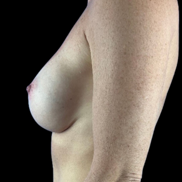 photo after breast augmentation procedure