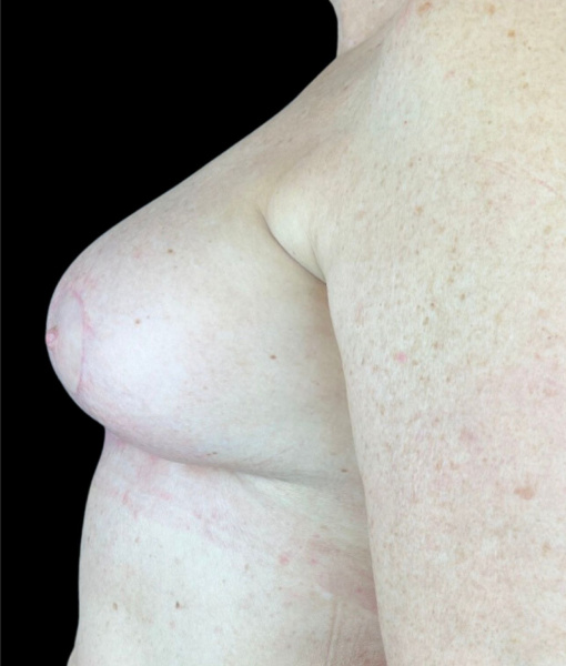 photo after breast reduction procedure