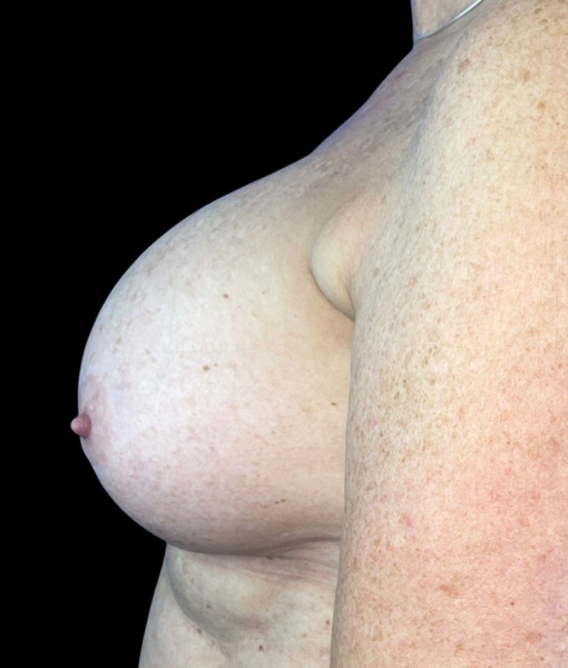 photo before breast reduction procedure