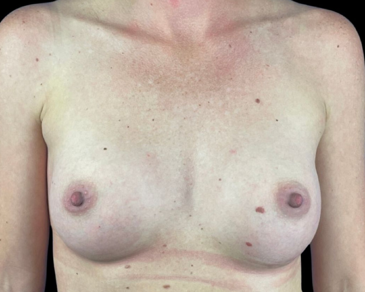 Female patient after breast augmentation