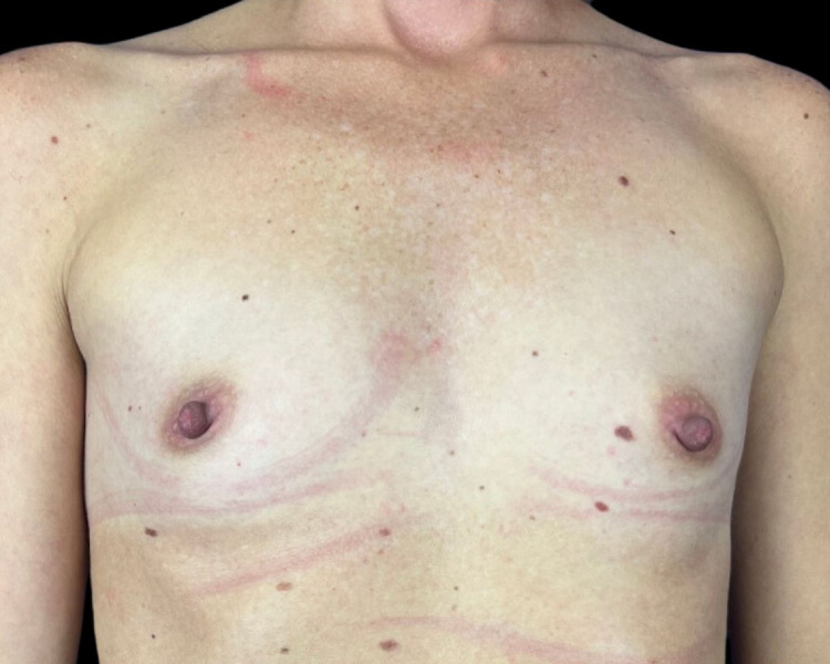 Female patient before breast augmentation