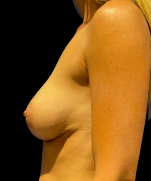 photo after breast revision procedure
