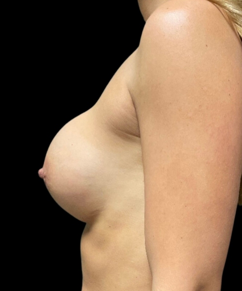 photo before breast revision procedure