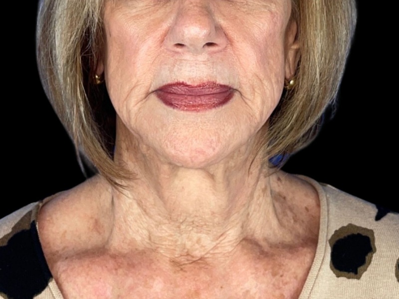 photo before neck lift procedure