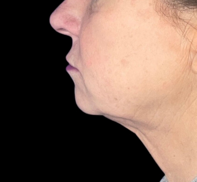 Female patient after neck lift