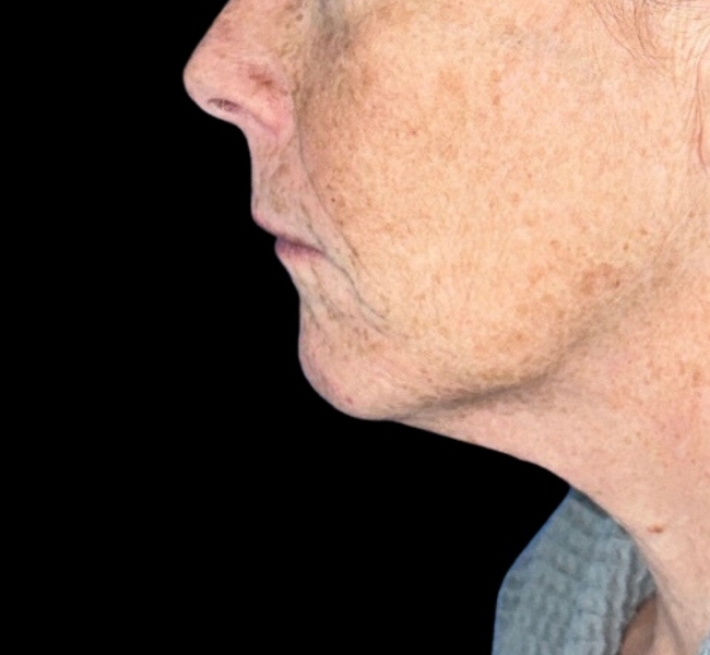 Female patient before neck lift