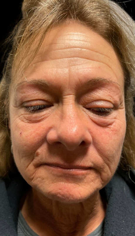 Women's face before filler, wrinkle relaxer and morpheus8 treatment
