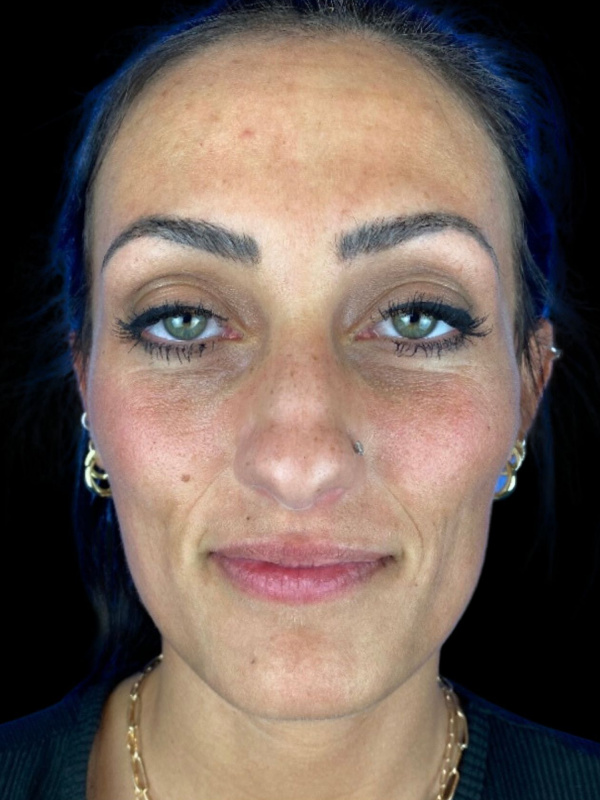 Woman's face before Facial Rejuvenation treatment