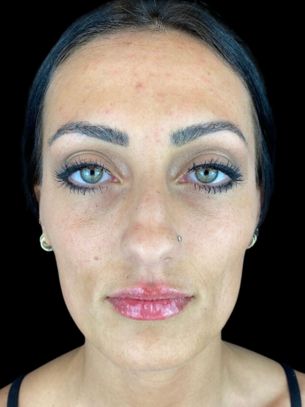 Woman's face after Facial Rejuvenation treatment