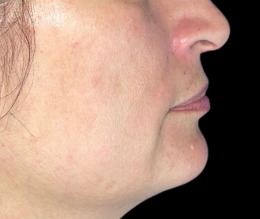 Woman's face after Lumecca treatment