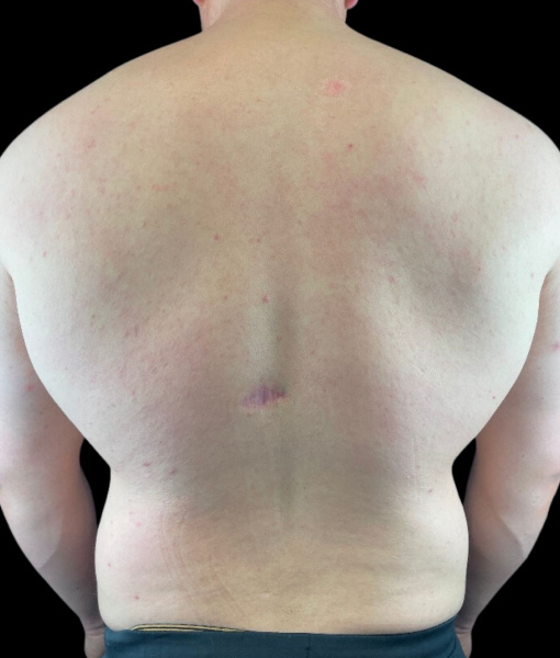 man's back after Lumecca treatment