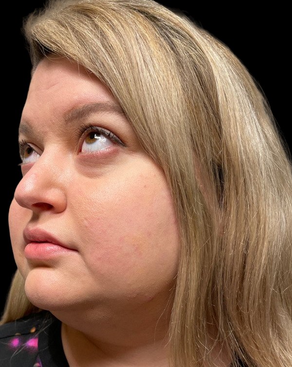 Female patient's face before liposuction