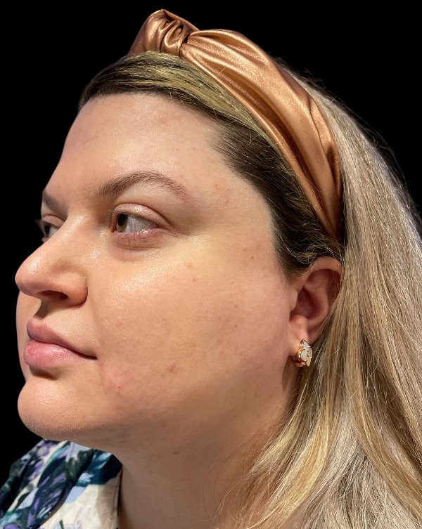 Female patient's face after liposuction