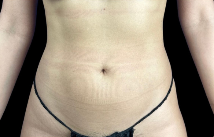 photo after liposuction procedure