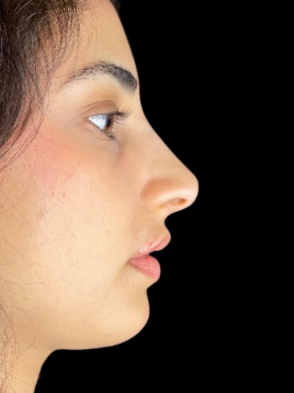 Woman's face after Liquid Rhinoplasty treatment