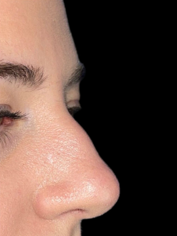Woman's face before Liquid Rhinoplasty treatment