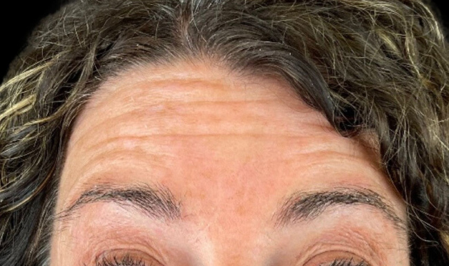 Female patient's forehead before wrinkle botox treatment