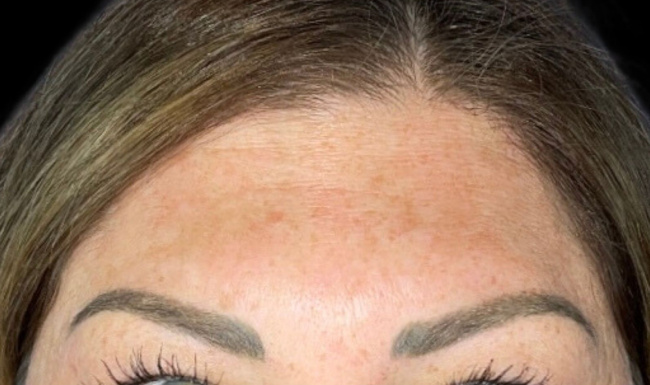 Female patient's forehead after wrinkle botox treatment
