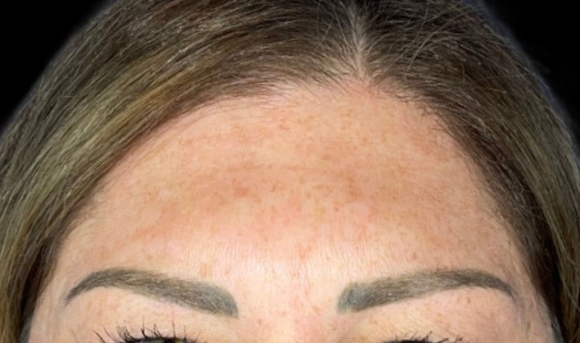 Female patient's forehead after wrinkle botox treatment