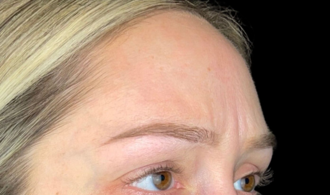 Female patient's forehead before wrinkle botox treatment