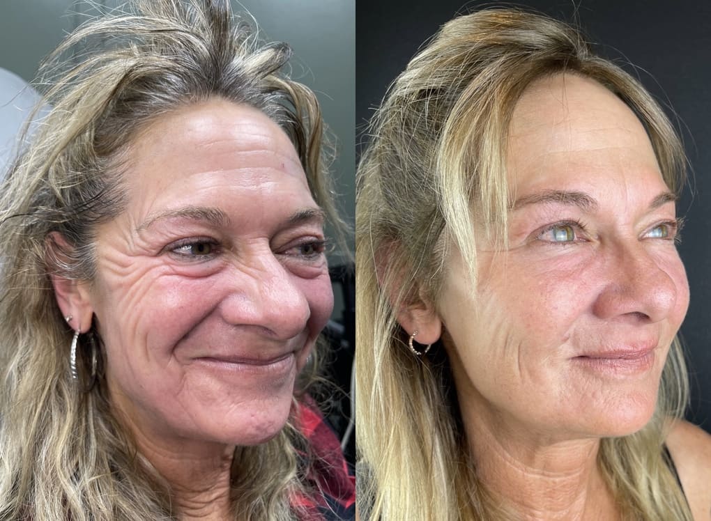 patient before and after non-surgical procedure