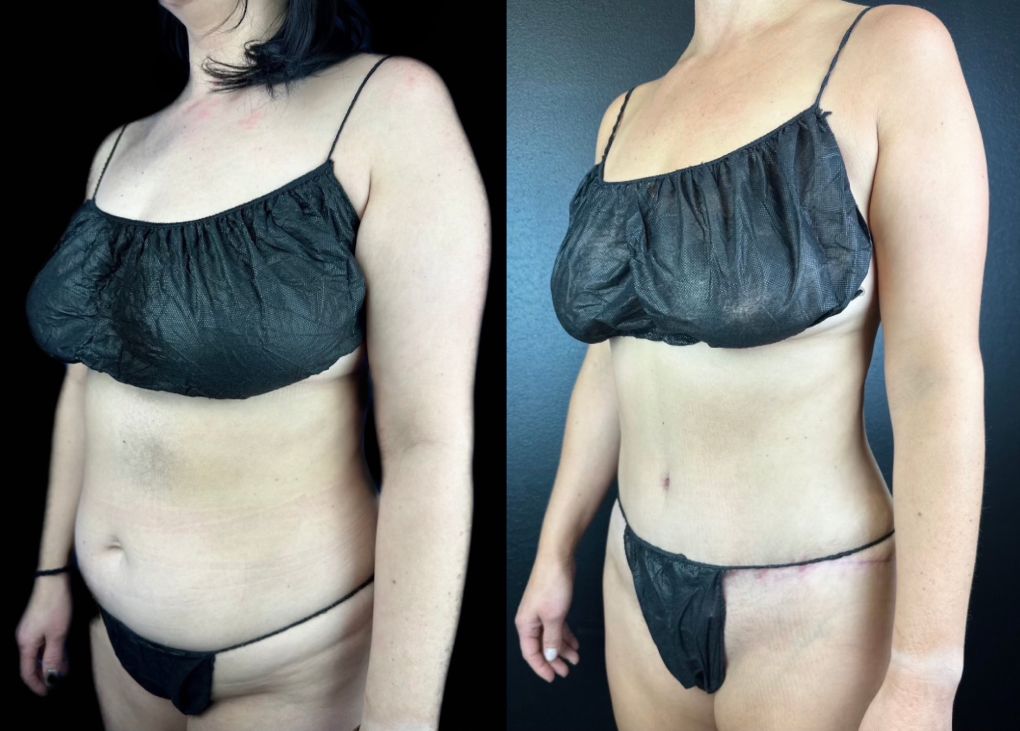 patient before and after Tummy Tuck procedure